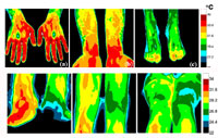 Abby Vogel compares thermal data between a normal volunteer (top) and a patient (bottom).