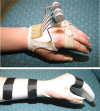 A metacarpophalangeal extension splint used to strengthen muscles and improve extension (top). A customized resting hand splint used to maintain joint alignment and functional hand positioning (bottom).